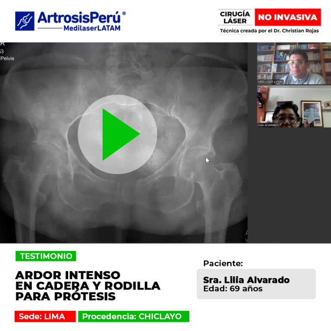 Ardor intenso en cadera y rodilla: paciente de Chiclayo evita la prótesis mediante tecnología láser que regenera y elimina el dolor crónico.