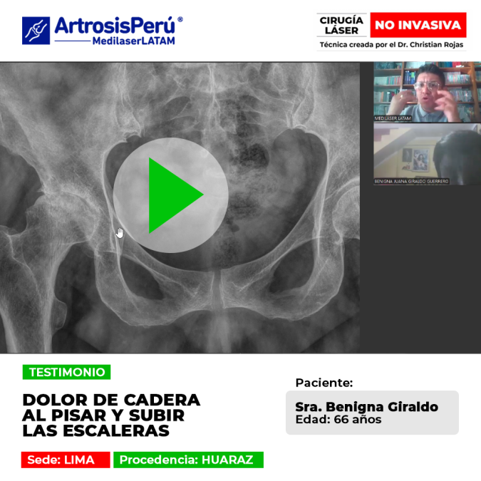 Dolor de cadera al pisar y subir escaleras: tratamiento láser avanzado para recuperar la movilidad funcional sin cirugías invasivas.