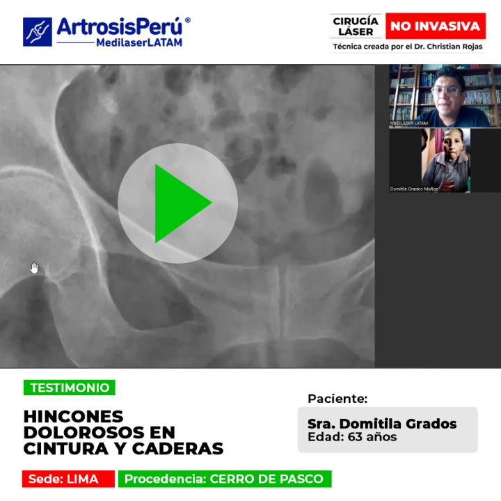 Hincones dolorosos en cintura y caderas: conoce el procedimiento láser que detiene el desgaste y elimina los pinchazos de forma ambulatoria.