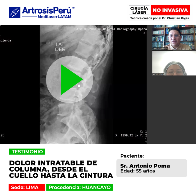 Dolor intratable de columna desde el cuello a la cintura. Mira cómo el tratamiento láser médico logra aliviar estas dolencias crónicas.
