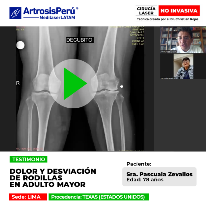 La artrosis causa deformidad. Conoce esta alternativa para corregir el dolor articular sin prótesis invasivas.