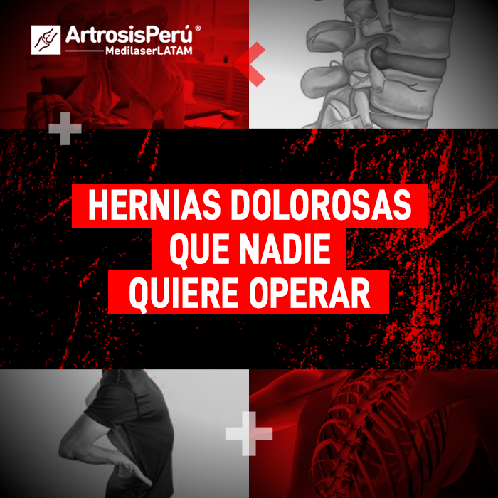 Hernias dolorosas que nadie quiere operar. Conoce las alternativas de tratamiento láser médico para aliviar el dolor sin cirugía abierta.