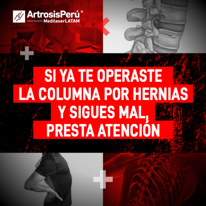 ¿Dolor tras cirugía de columna? El Dr. Rojas explica por qué las molestias persisten y cómo el láser médico es la solución definitiva.
