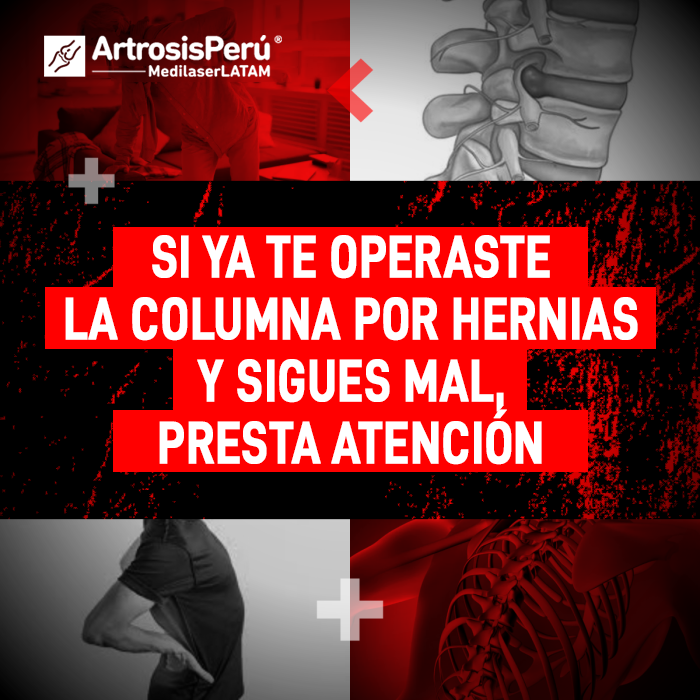 ¿Dolor tras cirugía de columna? El Dr. Rojas explica por qué las molestias persisten y cómo el láser médico es la solución definitiva.