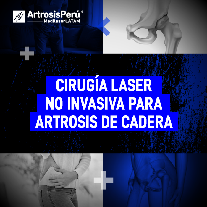 Cirugía láser no invasiva para Artrosis de cadera. Descubre cómo esta tecnología médica ayuda a recuperar la movilidad y reducir el dolor.