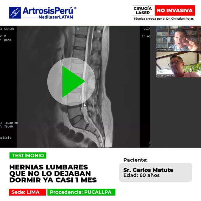 Hernias lumbares que no lo dejaban dormir. Mira cómo el tratamiento láser médico logra aliviar estas dolencias crónicas en Medilaser Latam.