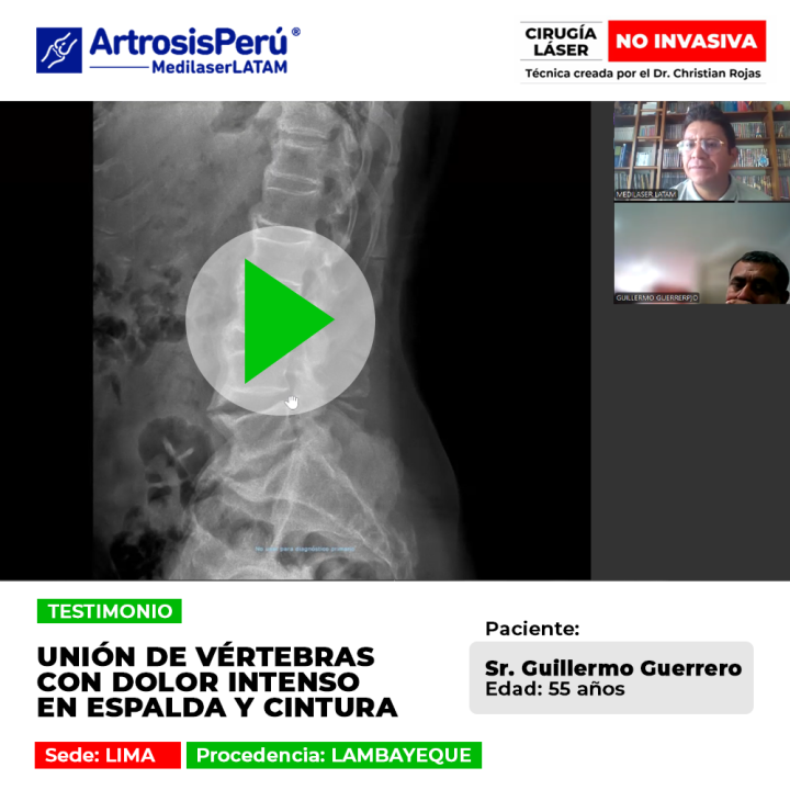 Unión de vértebras y dolor lumbar. ¿Es posible evitar la cirugía de columna? Descubre cómo el tratamiento láser médico logra este resultado.