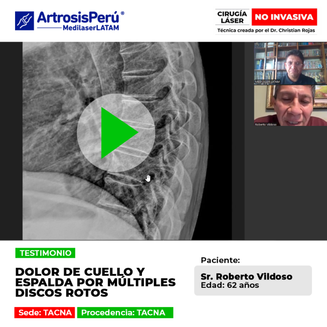 ¿Discos rotos en la columna? Descubre un procedimiento de vanguardia para regenerar tu espalda y eliminar molestias crónicas.