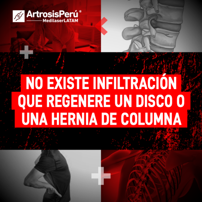 Descubre la realidad sobre las infiltraciones en la columna y conoce por qué no logran la regeneración de un disco dañado.