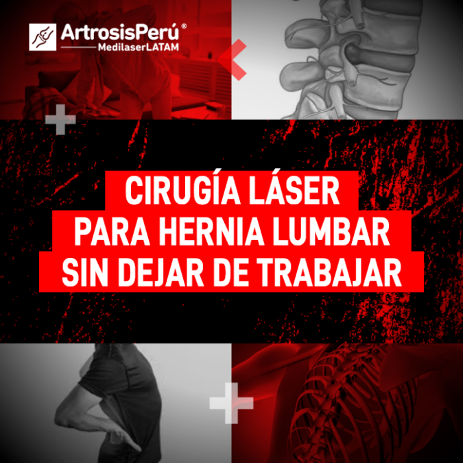 ¿Hernia lumbar? Conoce el procedimiento láser ambulatorio que permite eliminar el dolor y retomar tus labores sin reposos prolongados.