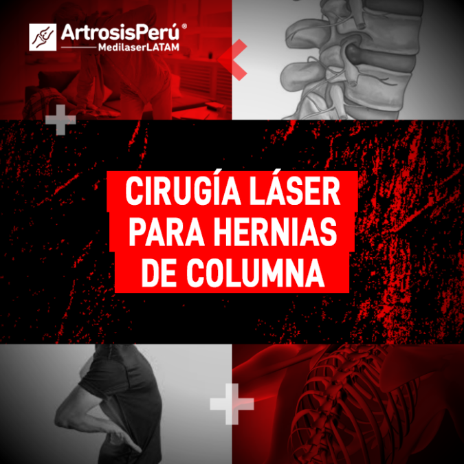La tecnología láser ofrece una alternativa moderna para tratar hernias de columna sin cirugías abiertas. Recupera tu bienestar físico.
