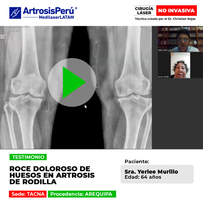 ¿Sientes que tus huesos rozan al caminar? Descubre cómo el tratamiento médico de Medilaser LATAM detiene el desgaste articular sin prótesis.