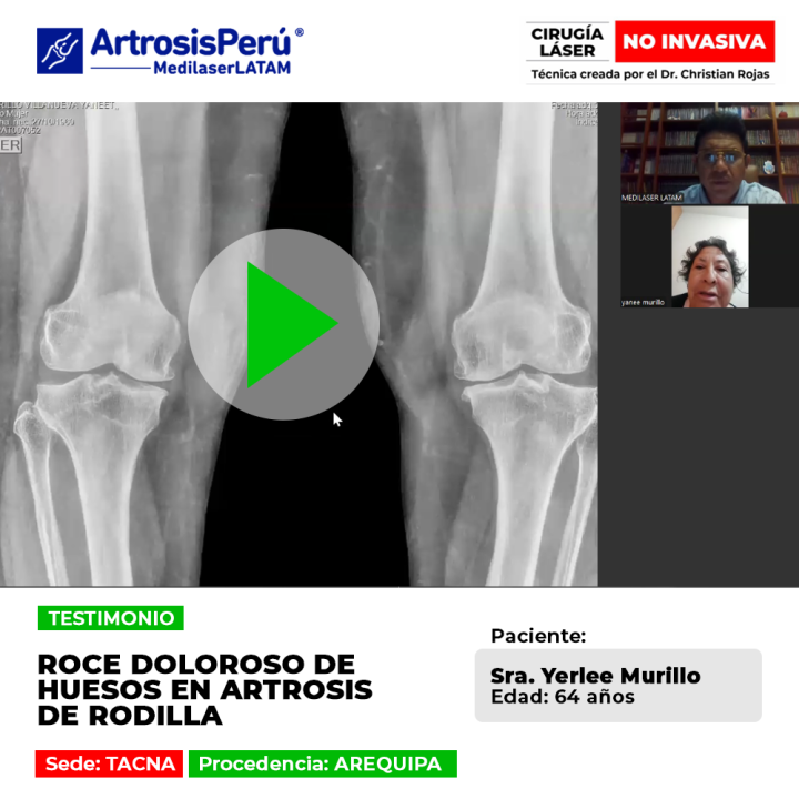 ¿Sientes que tus huesos rozan al caminar? Descubre cómo el tratamiento médico de Medilaser LATAM detiene el desgaste articular sin prótesis.