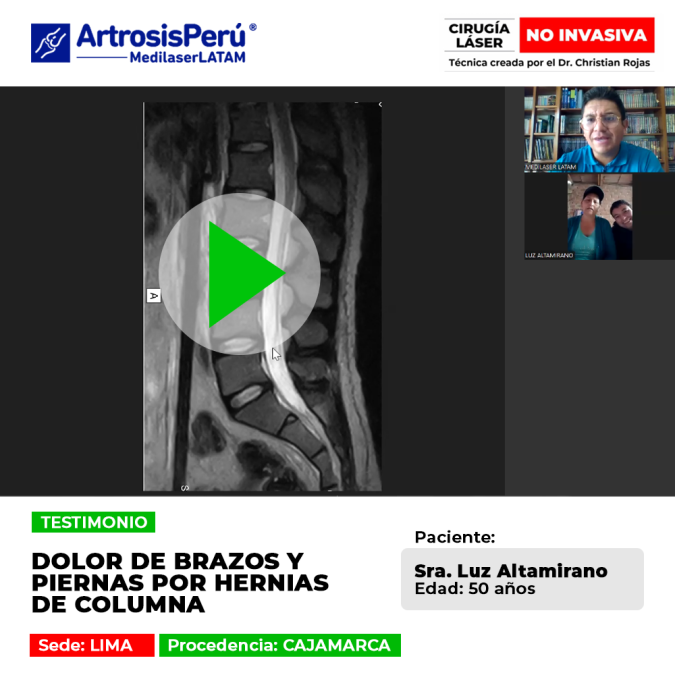 Las hernias pueden irradiar dolor a brazos y piernas. Conoce este procedimiento láser ambulatorio para liberar los nervios de forma segura.