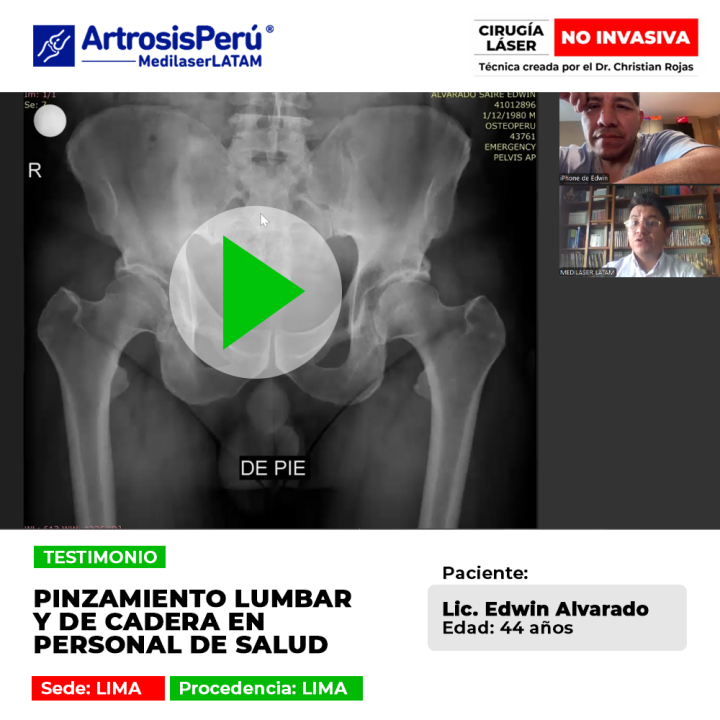 El pinzamiento lumbar y de cadera afecta gravemente el desempeño del personal de salud. Descubre la tecnología médica que permite una recuperación rápida y sin cortes.