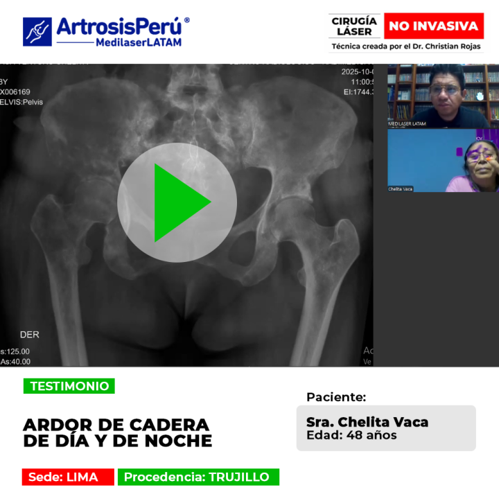 Encuentra alivio para el ardor de cadera persistente con tratamientos modernos. Una historia real de recuperación y bienestar físico.