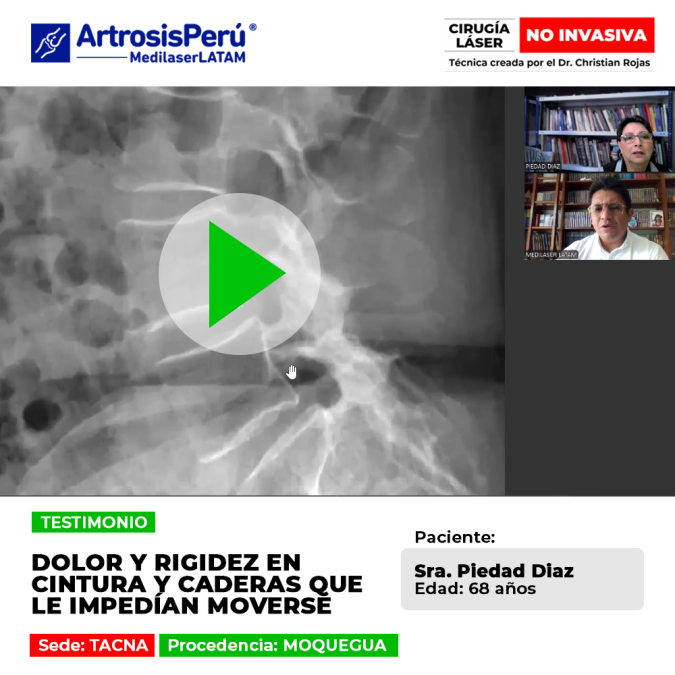 Conoce cómo superar la rigidez en cintura y caderas con tratamientos avanzados. Un testimonio real de recuperación y movilidad.
