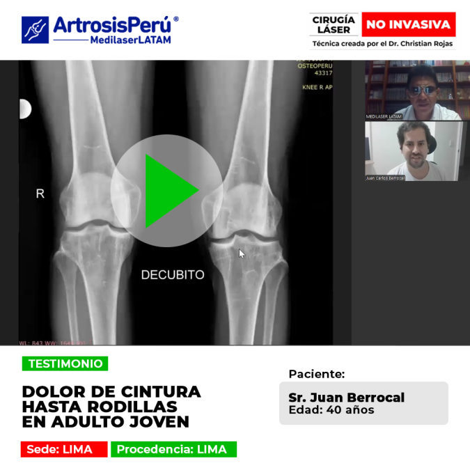 Conoce cómo un paciente joven logró superar el dolor lumbar irradiado a las piernas con tratamientos avanzados. Un testimonio real.