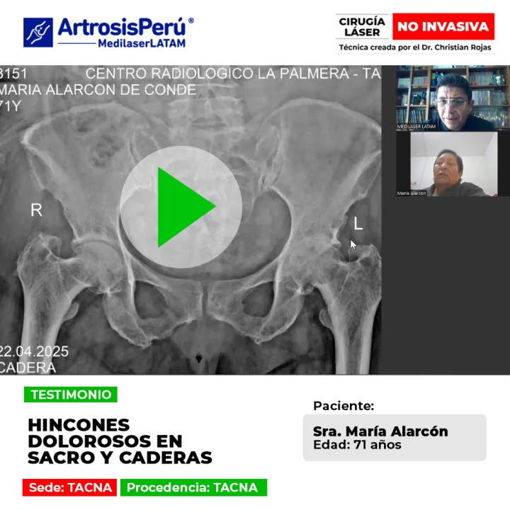 Supera las punzadas y el dolor severo en la zona del sacro y caderas. Conoce este tratamiento efectivo para recuperar tu bienestar.
