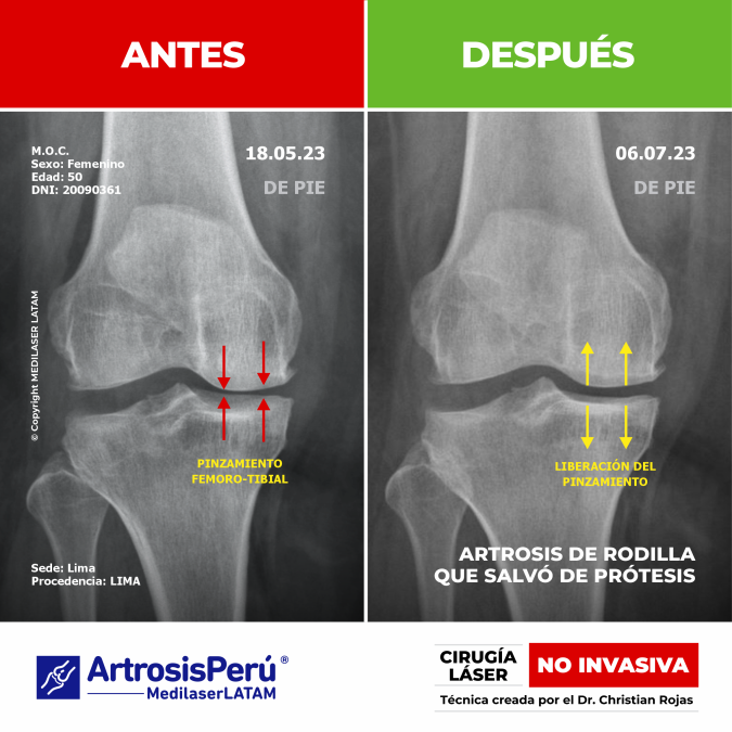 Evidencia científica de artrosis de rodilla avanzada que logró evitar la prótesis gracias al tratamiento de Cirugía Láser NO INVASIVA.