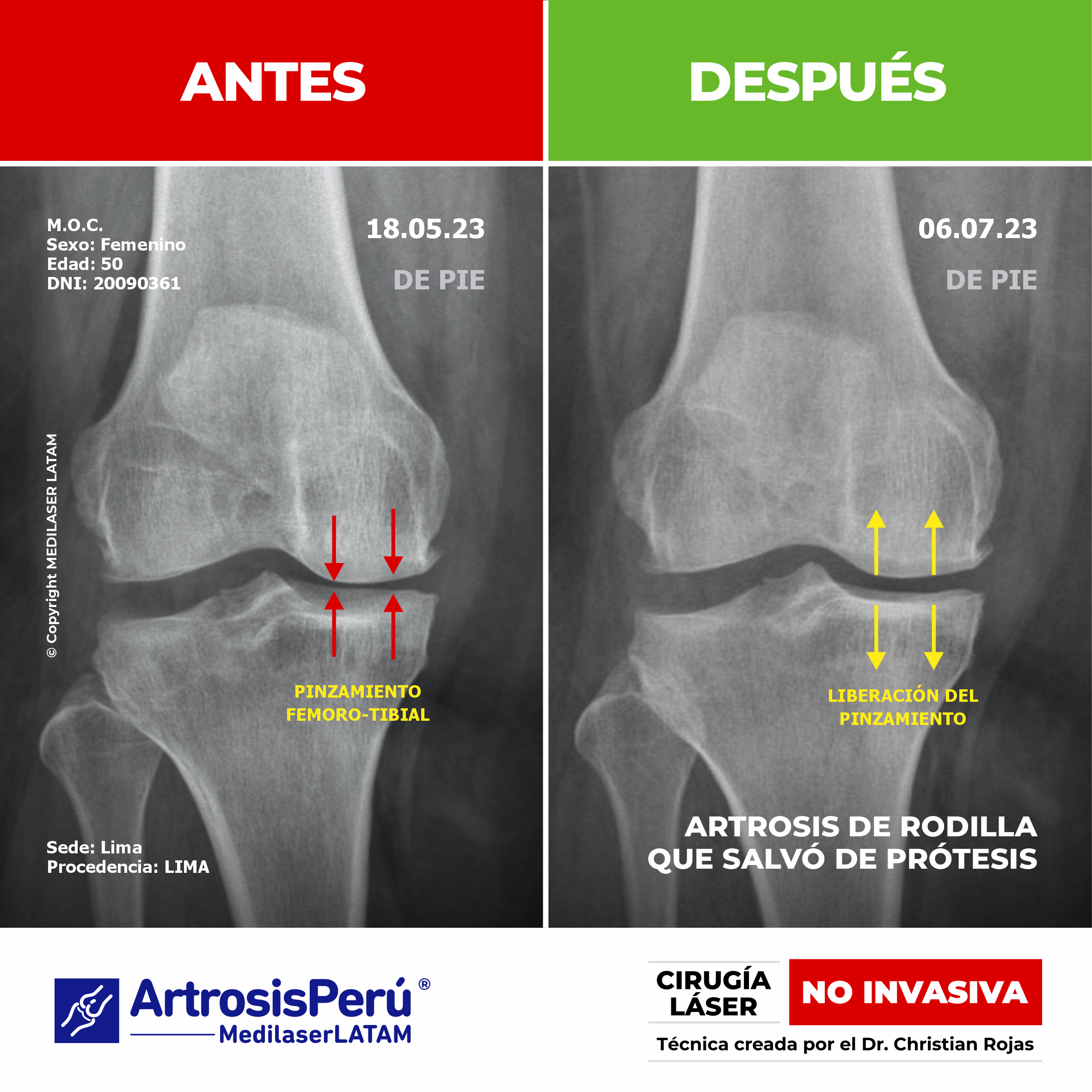 Evidencia científica de artrosis de rodilla avanzada que logró evitar la prótesis gracias al tratamiento de Cirugía Láser NO INVASIVA.