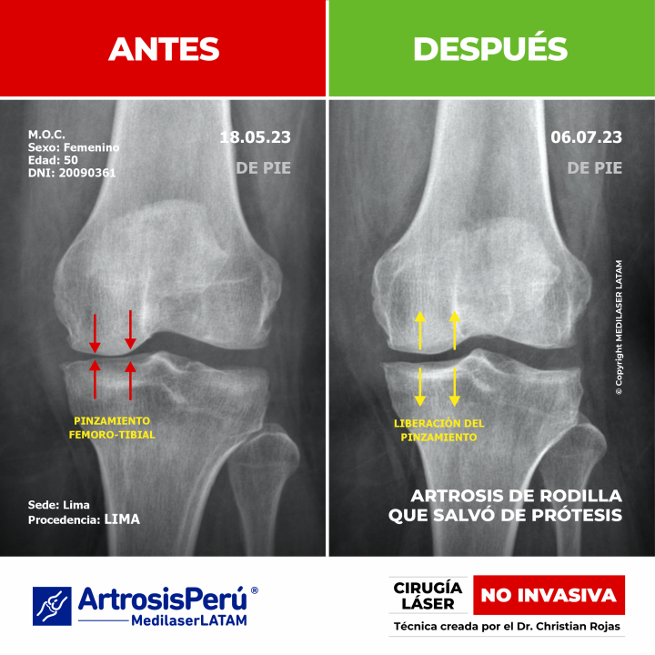 Documentación clínica de regeneración articular en rodilla. Cómo la tecnología láser ayuda a pacientes a evitar cirugías de prótesis.