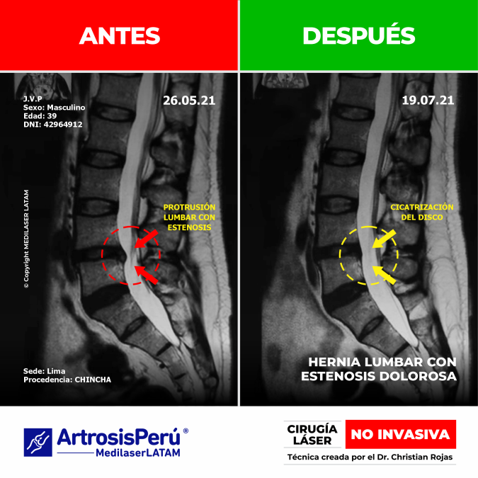 Evidencia de descompresión en hernia lumbar con estenosis dolorosa. Alivio del dolor de espalda con Cirugía Láser avanzada NO INVASIVA.