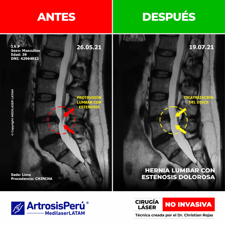 Evidencia de descompresión en hernia lumbar con estenosis dolorosa. Alivio del dolor de espalda con Cirugía Láser avanzada NO INVASIVA.