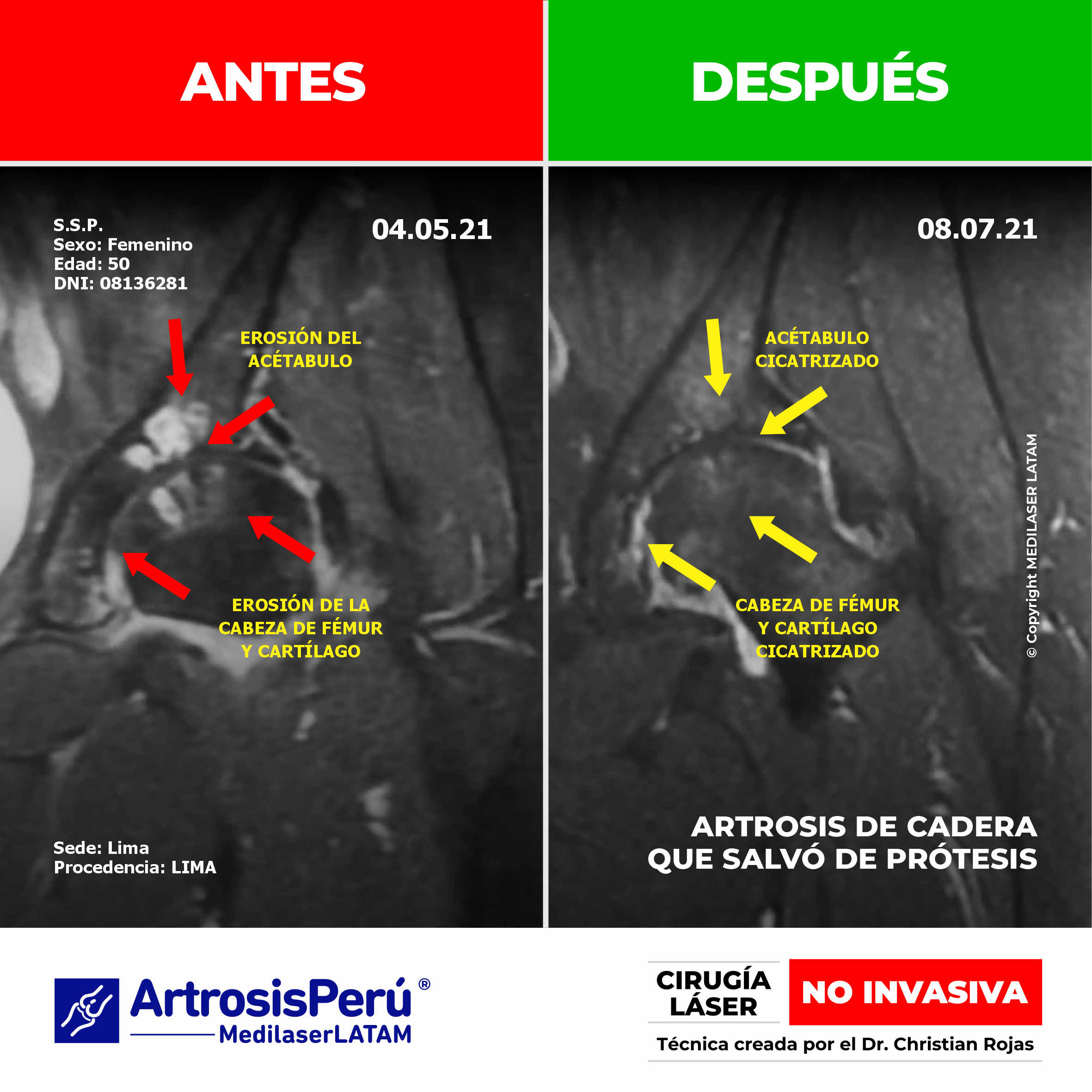 Caso radiológico de artrosis de rodilla severa con evolución favorable. Alternativa eficaz y NO INVASIVA para evitar el implante de prótesis.