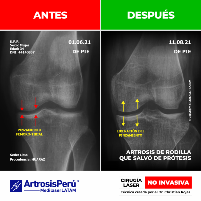 Radiografía de antes y después en desgaste severo de rodilla. Tratamiento médico láser que demostró evitar de forma efectiva la prótesis.