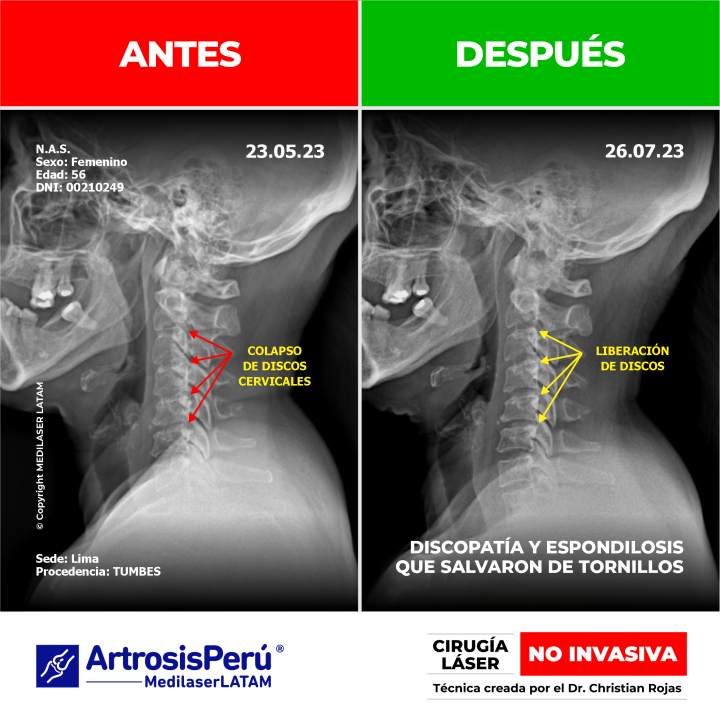 Evidencia científica de la regresión en artrosis cervical. Resultados clínicos comprobados con el tratamiento de Cirugía Láser NO INVASIVA.