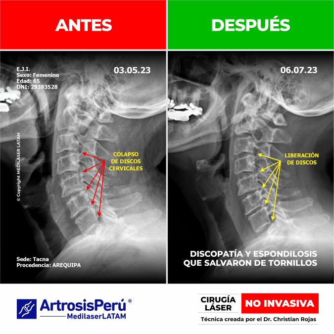 Documentación médica sobre la regresión en artrosis cervical. Alivio del dolor y recuperación articular con tecnología láser NO INVASIVA.