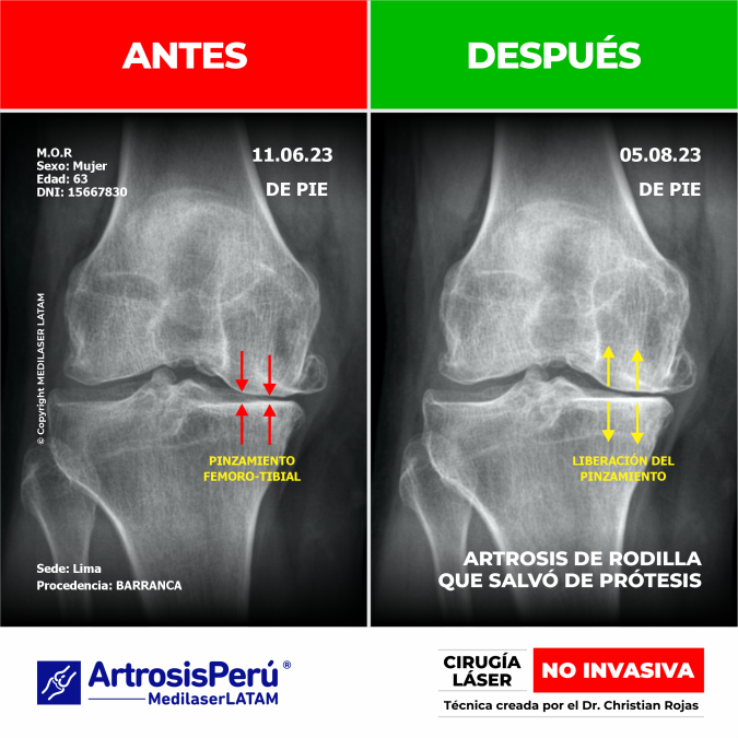 Estudio radiológico que demuestra la regresión en gonartrosis. Recuperación de la articulación de la rodilla con Cirugía Láser NO INVASIVA.