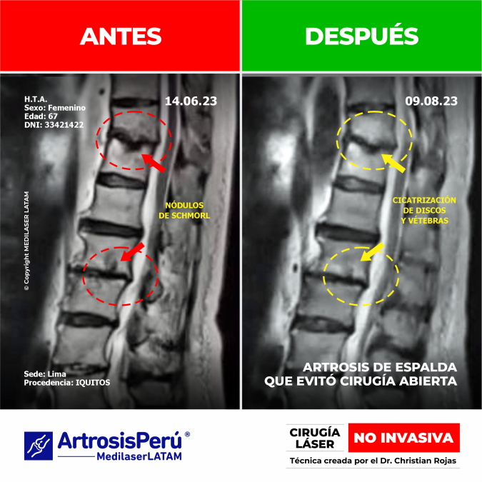 Evidencia clínica de regresión en artrosis de columna. Tratamiento avanzado y NO INVASIVO para la regeneración y descompresión articular.