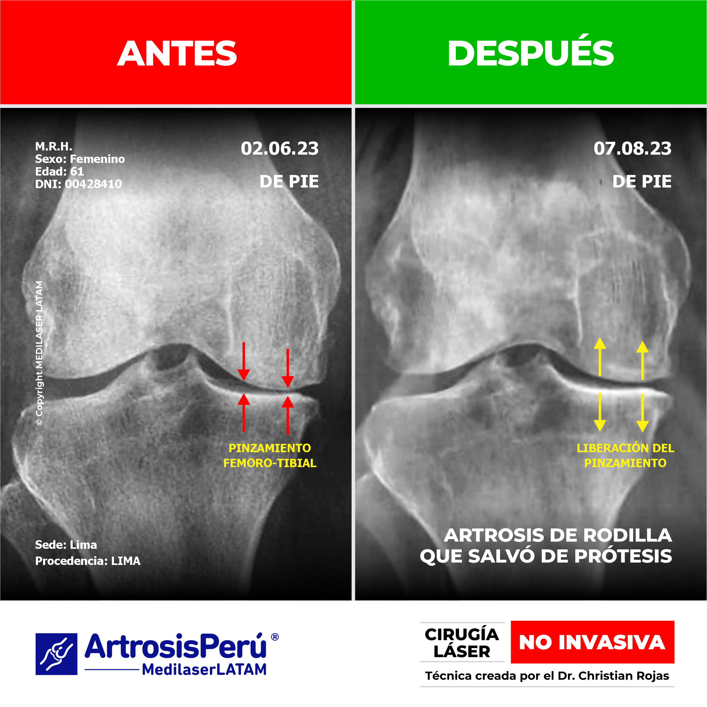 Casos clínicos de éxito que demuestran la regresión en artrosis mediante la aplicación de Cirugía Láser de columna y articulaciones.