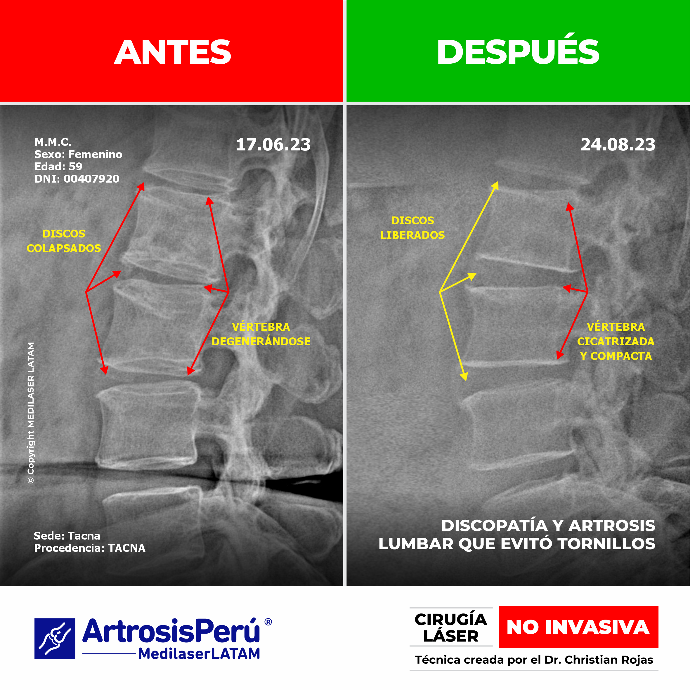 Documentación de la regresión en artrosis lumbar. Reducción del dolor de espalda baja con el tratamiento médico láser NO INVASIVO.