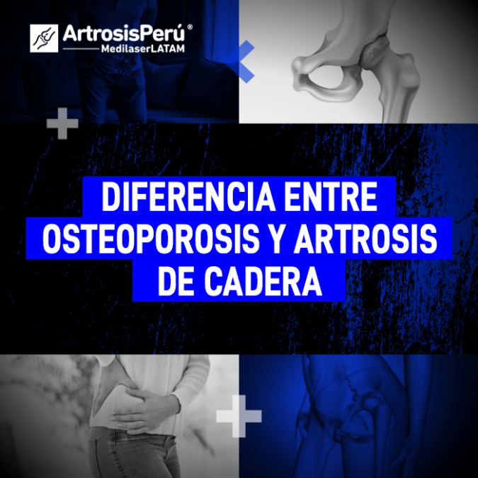 Aprende a distinguir entre el desgaste del cartílago articular y la pérdida de densidad ósea para buscar el tratamiento correcto.