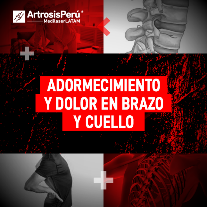 Si sientes hormigueo en las extremidades y rigidez cervical, descubre qué problemas de la columna podrían estar presionando tus nervios.