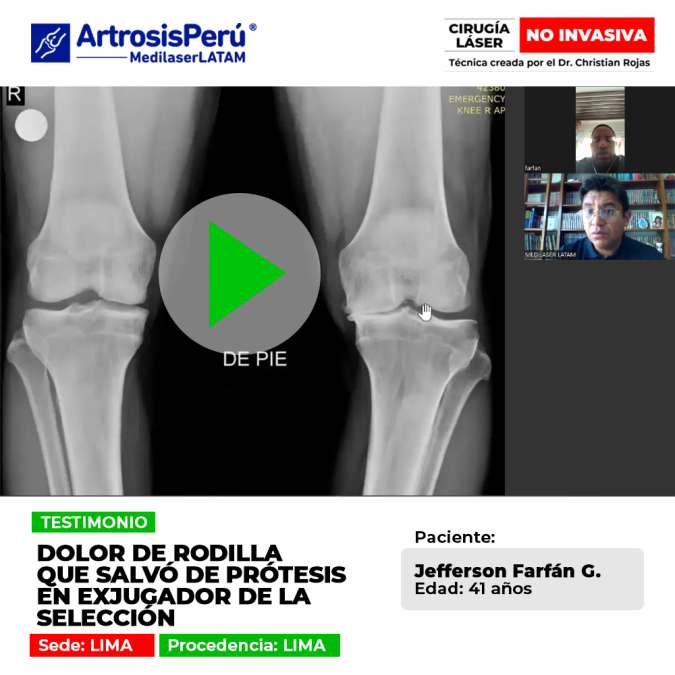 Descubre cómo la tecnología médica avanzada ayudó a un reconocido exfutbolista profesional a evitar una cirugía de prótesis.
