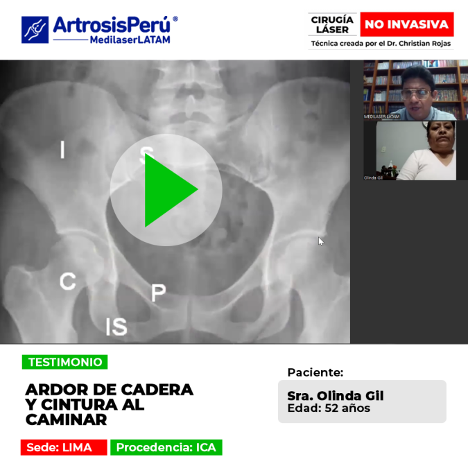¿Sientes quemazón constante al dar unos pasos? Conoce el testimonio de una paciente que alivió el ardor en cadera y zona lumbar.