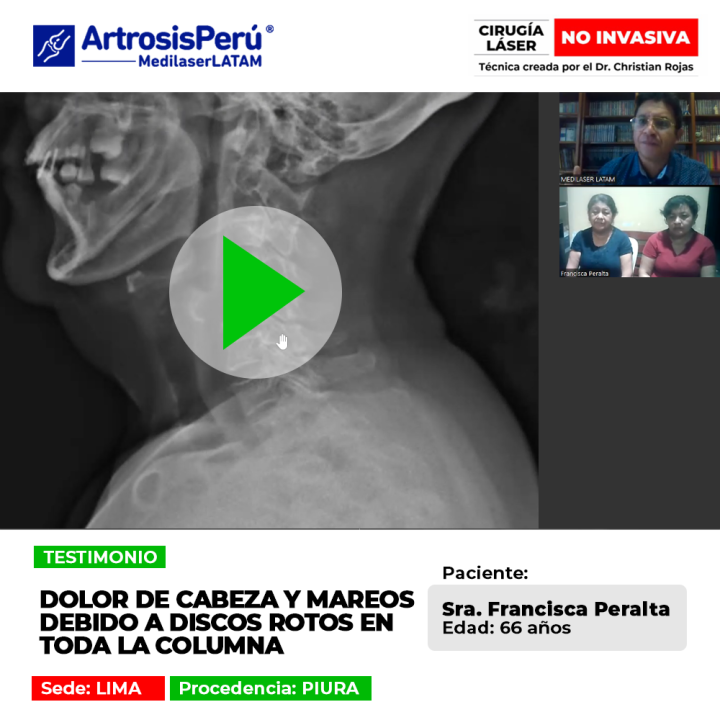 Infórmate sobre cómo las hernias de disco severas causan migrañas y mareos, y la solución médica que ayudó a la paciente.