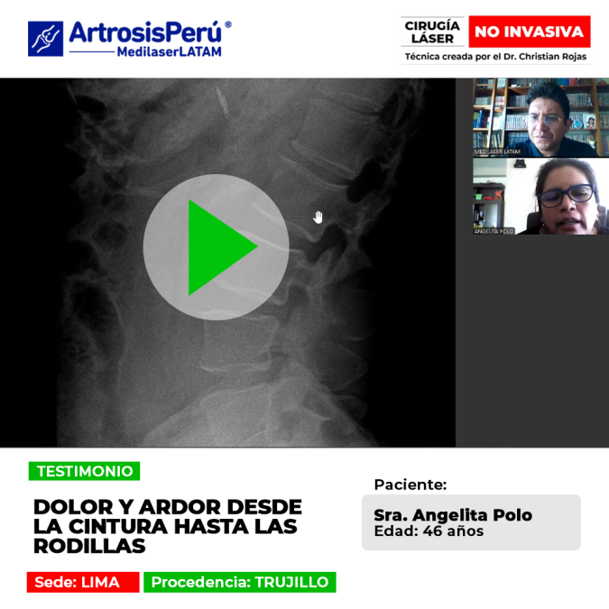 Descubre la historia de la paciente que logró aliviar la intensa quemazón y rigidez que se extendía por todas sus piernas.