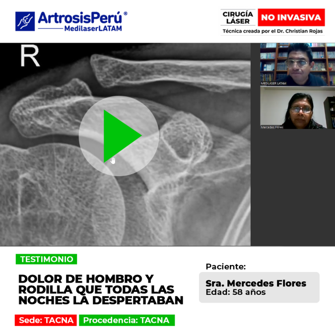 Una mirada al tratamiento médico que devolvió el descanso nocturno a una paciente que sufría por desgaste articular severo.
