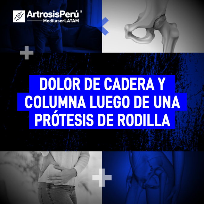 Entiende por qué puede aparecer un fuerte dolor de cadera o malestar lumbar tras someterte a una cirugía de reemplazo articular.