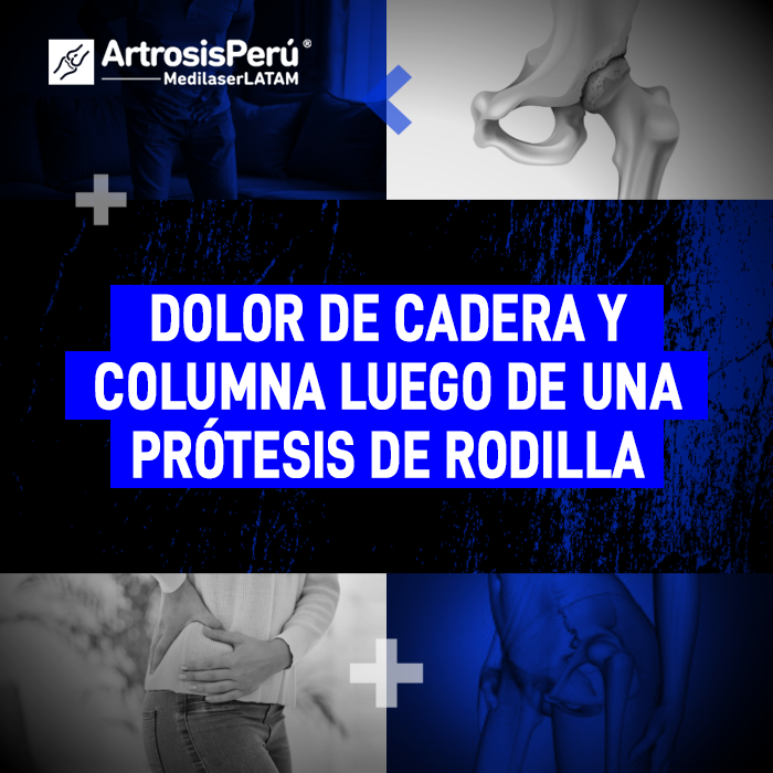 Entiende por qué puede aparecer un fuerte dolor de cadera o malestar lumbar tras someterte a una cirugía de reemplazo articular.