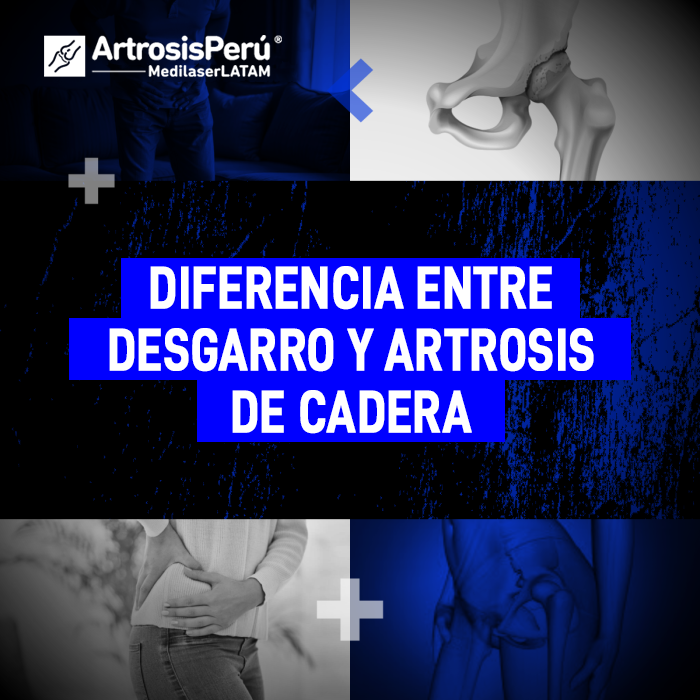 La artrosis de cadera y un desgarro muscular comparten síntomas pero requieren manejos distintos. Conoce cómo diferenciarlos médicamente.
