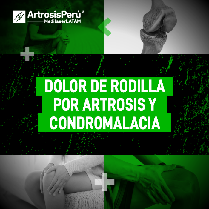 El dolor de rodilla por artrosis y condromalacia rotuliana afecta tu movilidad diaria. Descubre el origen exacto de este malestar.