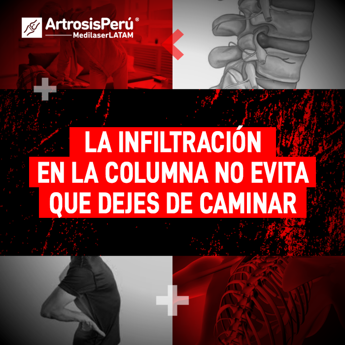 Conoce la realidad sobre la infiltración en la columna y por qué este procedimiento no garantiza detener la pérdida de movilidad.