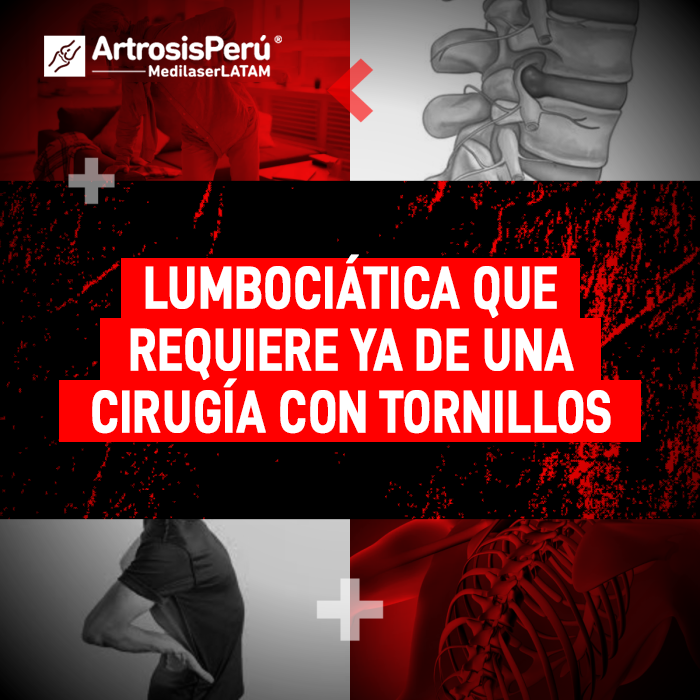 La lumbociática severa puede hacerte creer que la fijación con tornillos es tu única opción. Infórmate sobre esta condición aquí.