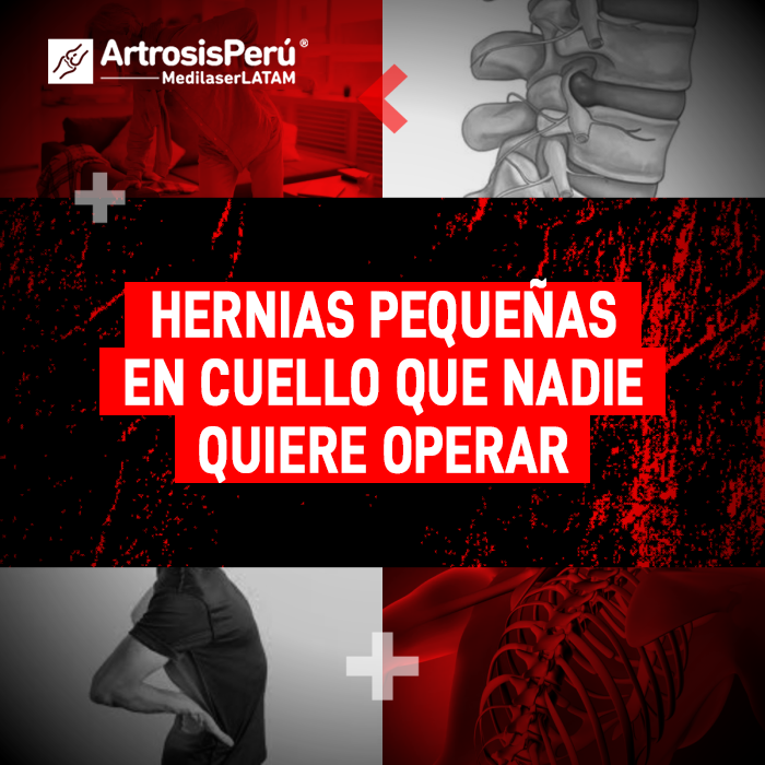 Las hernias pequeñas en cuello también producen un dolor severo e invalidante. Entiende por qué ocurren y cómo tratarlas eficazmente.